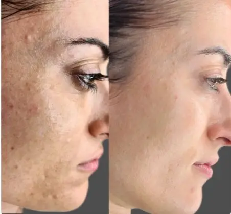 Bio-Microneedling