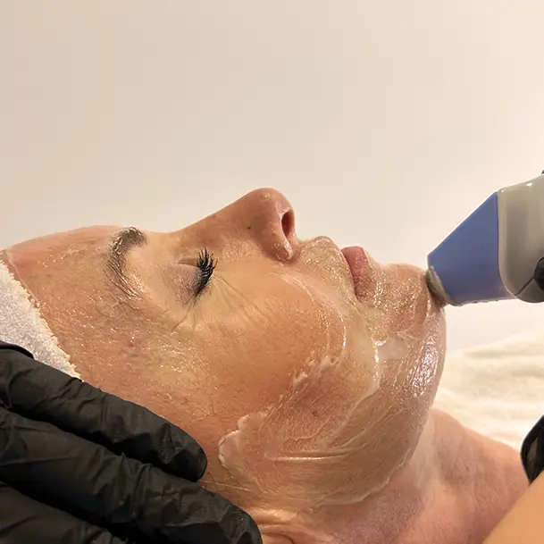 Exilis Facial (1 Zona)