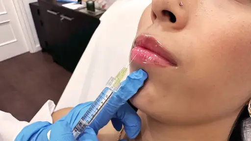 Relleno Facial Labio Natural