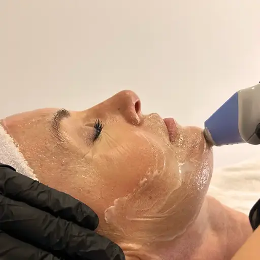 Exilis Facial (1 Zona)